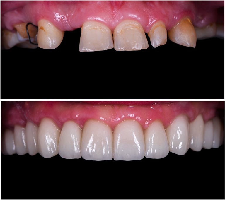 Dental Crowns and Bridges Houlik Family Dentistry Dentist Wichita 67205