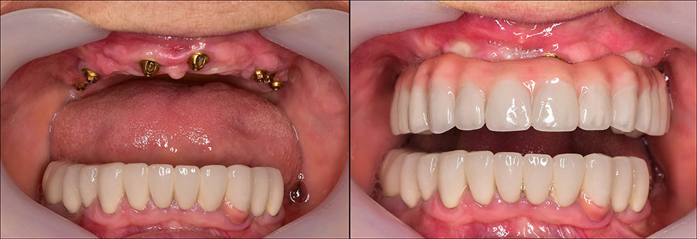 dentalimplants2