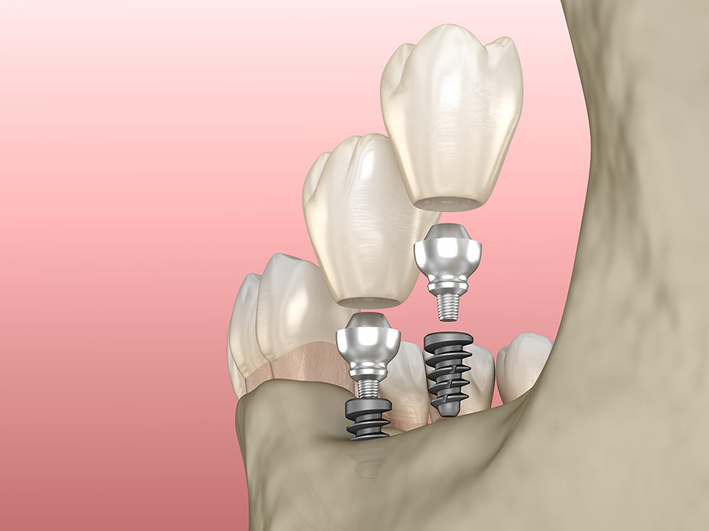 minidental minidental