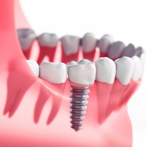 Average cost of dental implants Dr. Joseph Houlik Dr. Lily Wakim Houlik Family Dentistry. General, Cosmetic, Preventative, Family Dentistry in Wichita, KS 67205